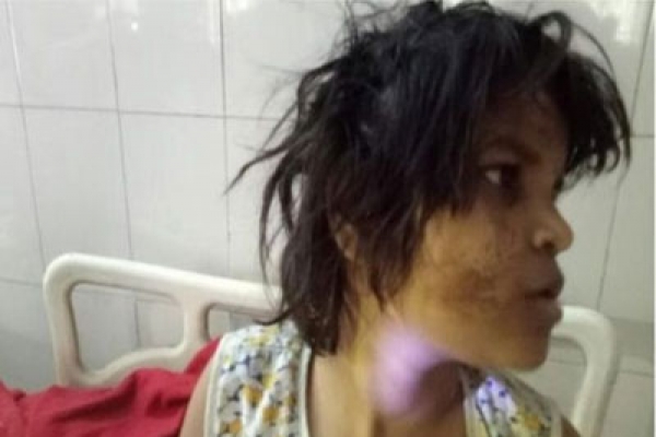 কথা বলতে শুরু করেছে ভারতের ‘বানর-কন্যা’