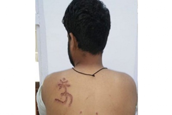 ভারতে মুসলিম বন্দির গায়ে গরম লোহা দিয়ে লেখা হলো হিন্দুদের ধর্মীয় চিহ্ন ‘ওঁ’