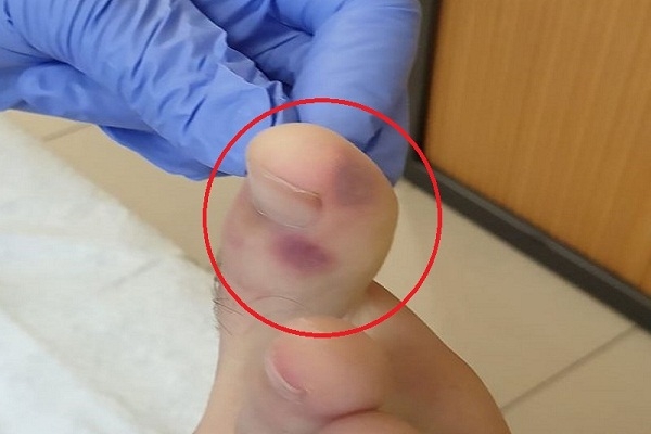 এবার পায়ে দেখা যাচ্ছে করোনায় আক্রা'ন্তের চিহ্ন?