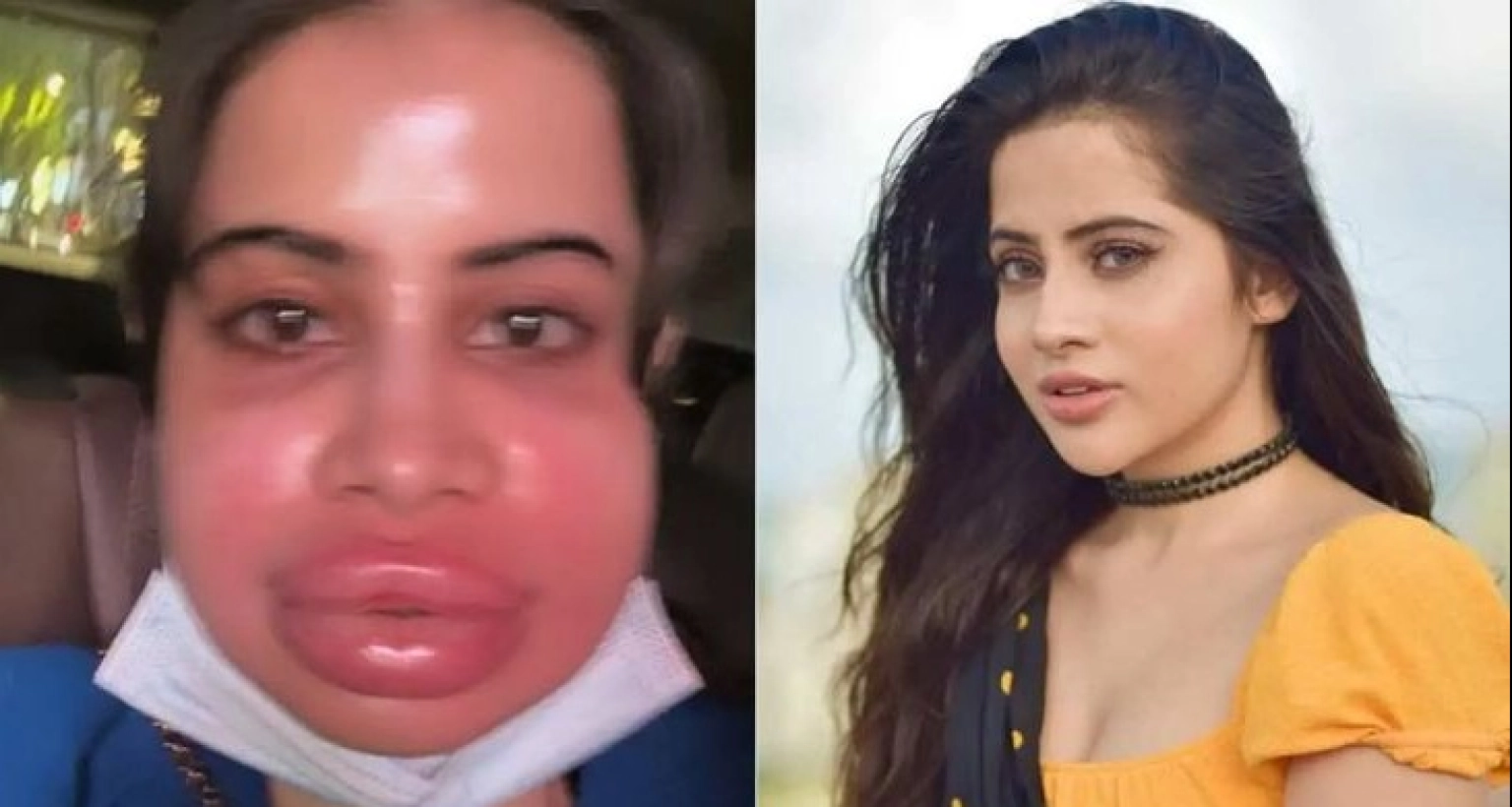  উরফি জাভেদের ঠোঁটের বেহাল দশা!