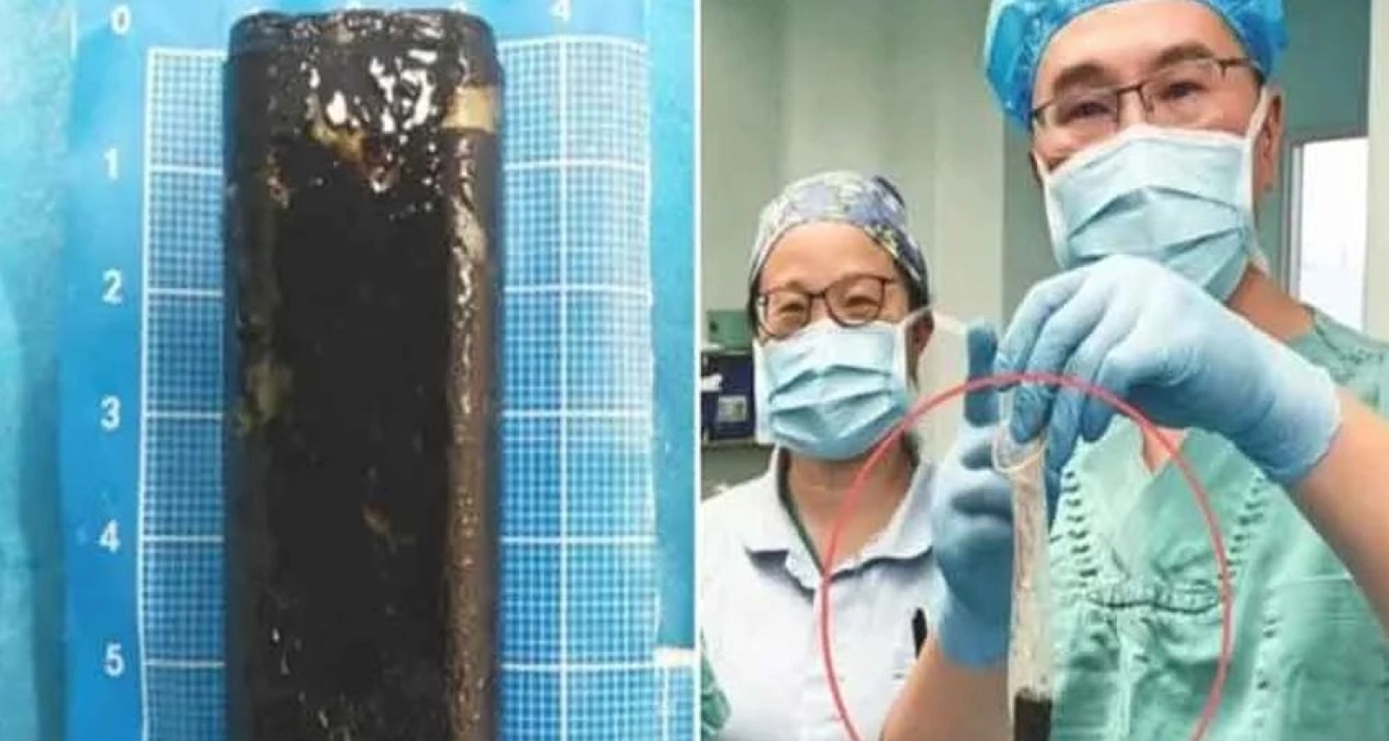 ৩০ বছর পর রোগীর পেট থেকে বের করা হলো সিগারেটে আগুন ধরানোর লাইটার