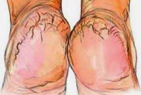 শীতে পা ফাটলে যা করবেন