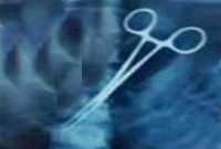 পনেরো বছর ধরে হজযাত্রীর পেটে কাচি!