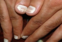 নখ দেখে রোগ চিনুন 