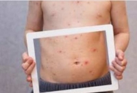 আইপ্যাড থেকে অ্যালার্জি!