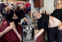 ৬৩ বছরের জোড়লাগা যমজ হচ্ছেন রনি ও ডনি!