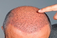 নতুন চুল গজানোর একটি দারুণ কার্যকরী পদ্ধতি