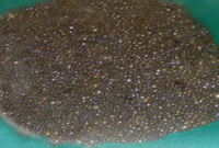 রোগীর পেটে ১২ হাজার পাথর!