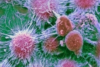 অধিকাংশ মানুষ শুধুমাত্র একটি কারণে ক্যান্সারে আক্রান্ত হয়!