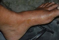 সাপে কামড় দিয়েছে কি না বোঝার ৭ লক্ষণ