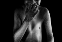 বিশ্বের মাত্র ৯জন এই বিরল রোগে আক্রান্ত