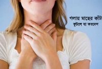 গলায় মাছের কাঁটা ফুটলে নিস্তার পাবেন যেভাবে