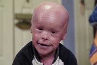 মাত্র ৫ বছরেই যেন ৫০ বছরের বুড়ো, এ রোগের কোনো চিকিৎসা নেই!