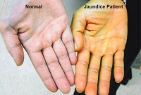 জন্ডিস হলে এই ৯টি কাজ করতে পারেন, দ্রুত সেরে যাবে