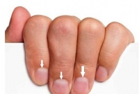  নখের নিচে সাদা দাগ কিসের ইঙ্গিত?