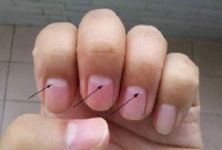 নখের উপর এই অর্ধচন্দ্র থাকলে স্বাস্থ্য সম্পর্কে সাবধান!