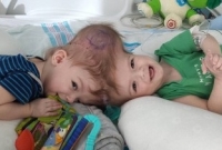 দুই ভাইয়ের মাথা আলাদা করল বিজ্ঞান, কীভাবে?