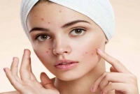 শীতকালে ব্রণ দুর করার উপায়