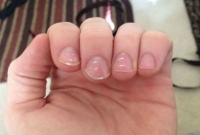 হাতের নখে সাদা দাগ! সাবধান...