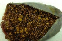 পিত্তথলি নাকি পাথরের খাদান! রোগীর পেট থেকে মিলল ১১,৮১৬ স্টোন