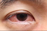 মহিলার চোখ থেকে বেরিয়ে এল ৭০ মিলিমিটার লম্বা কৃমি!