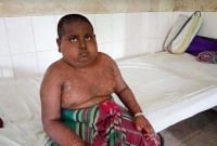 অজানা রোগে আক্রান্ত শিশু মিরাজকে ঢাকা আনা হয়েছে