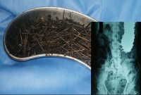 রোগীর পেট থেকে বের হলো ৬৩৯টি লোহার পেরেক