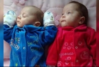 অবিশ্বাস্য ঘটনাঃ মৃত মায়ের গর্ভ থেকে ১২৩ দিন পর দুই সন্তানের জন্ম!