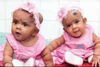 বাড়িতে বিদ্যুৎ নেই, গরমে অসুস্থ জোড়া লাগানো জমজ বোন তোফা-তহুরা