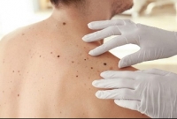 আপনার শরীরে কি অনেক তিল রয়েছে? তাহলে কিন্তু সুখবর