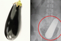 অবশেষে অস্ত্রোপচার করে বের করা হয়েছে সেই বেগুন!