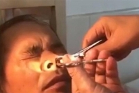 দু’সপ্তাহ ধরে নাক থেকে রক্তপাত, শেষে যা বেরলো, নার্স অজ্ঞান!