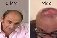 বিজ্ঞাপনে আকৃষ্ট হয়ে টাক মাথায় চুল বসাতে গিয়ে অভিনেতার এ কী হাল!