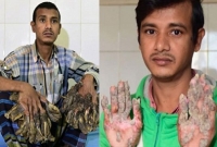 ফের হাতে পায়ে শেকড়, ভুল স্বীকার করে হাসপাতালে বৃক্ষমানব