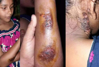 সৎ ভাই ধরে রাখে, সৎ মা দেয় গরম খুন্তির ছেকা!