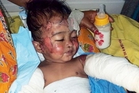 আগুনে দগ্ধ বাচ্চাটার ‘শরীর থেকে খসে পড়ছে চামড়া, ব্যান্ডেজ করেই ছেড়ে দিল হাসপাতাল’