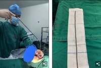 ১১ বছরের শিশুর লিঙ্গের ভেতর ৭০টি চৌম্বক গুটি!