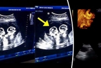 মায়ের পেটের মধ্যেই মারামারি করতে দেখা গেছে যমজ শিশুকে!