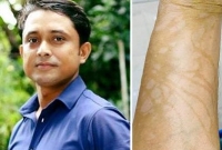 সঙ্গীতশিল্পী মিলার সাবেক স্বামী পাইলট সানজারিকে এসিড নিক্ষেপ