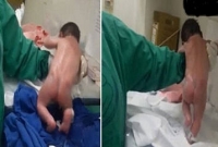  মিরাকল ঘটনা, জন্মের পর উঠে দাঁড়িয়ে হাঁটা শুরু করে এই শিশু