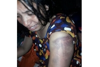 পীঠ ও হাত থেকে কোমর পর্যন্ত রড দিয়ে শিক্ষক স্বামীর পিটুনিতে শিক্ষিকা স্ত্রী মুমূর্ষু