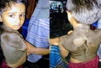 বিরল রোগে আক্রান্ত মুনিরা চিকিৎসা করাতে পারছেন না 