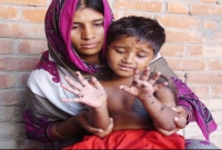 বিরল রোগে আক্রান্ত শিশুটি, পশুর লোমে ভরে যাচ্ছে তাসফিয়ার শরীর