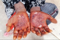 বাজার থেকে কেনা মেহেদীতে ঝলসে গেল ছাত্রীর হাত