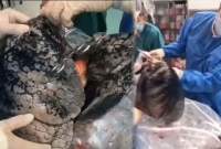 সিগারেটের ধোয়ায় বী'ভৎ'স কালো ফুসফুস, বিস্ময়ে হতবাক ডাক্তাররা