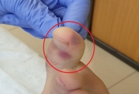 এবার পায়ে দেখা যাচ্ছে করোনায় আক্রা'ন্তের চিহ্ন?