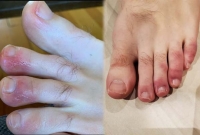 করোনার নয়া উপসর্গ 'কভিড ফিট', কী এই ফিট ও কেন হয়?