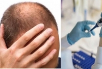 করোনায় টাকপড়া মানুষদের জন্য চাঞ্চ'ল্যকর তথ্য! মেনে নিতে নারাজ একদল বিজ্ঞানী