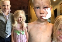 বোনকে বাঁ'চাতে ভাইয়ের মুখে ৯০ সেলাই