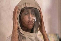 গত ২০ বছর ধরে হেলমেট পরে আছেন এই নারী!